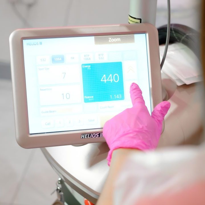 Laser Tattoo Removal - Image 3
