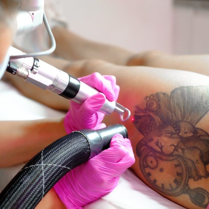 Laser Tattoo Removal