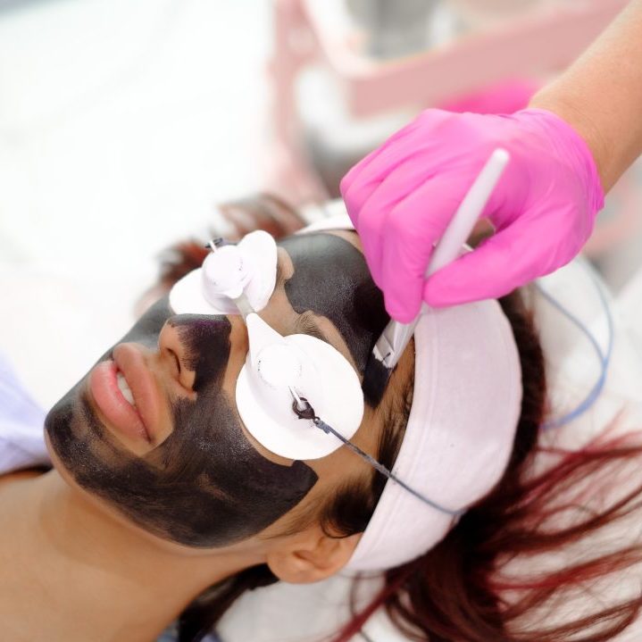 Carbon Laser Facial