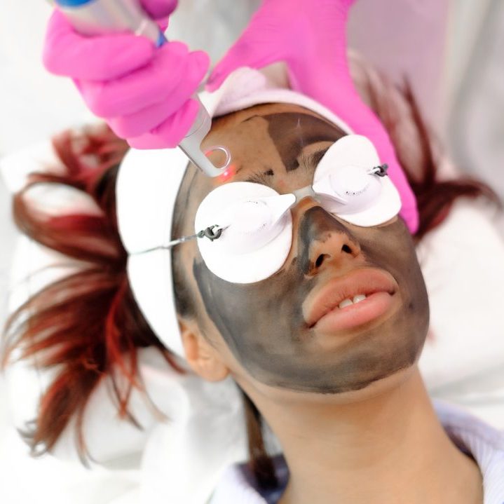 Carbon Laser Facial - Image 2